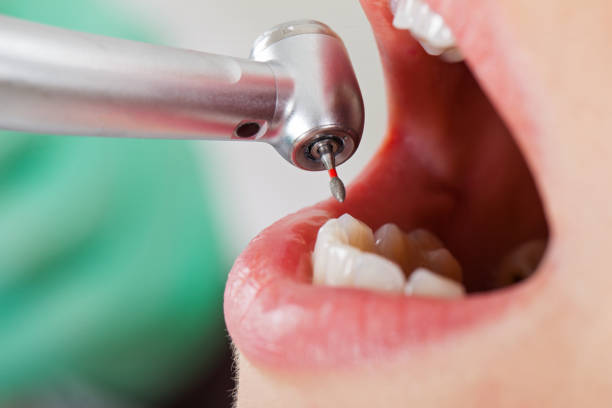 Best Emergency Tooth Extraction in Pecos, TX